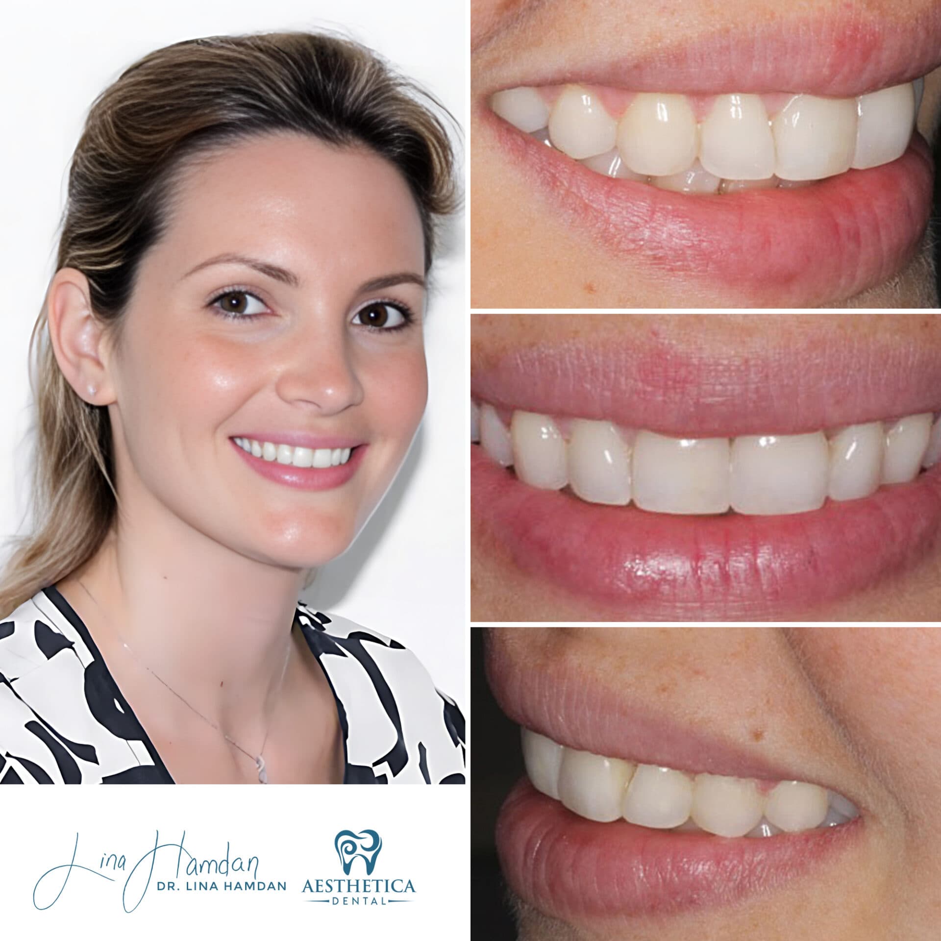 Teeth whitening result with Opalescence Boost®, anonymous patient at Aesthetica Dental Naperville