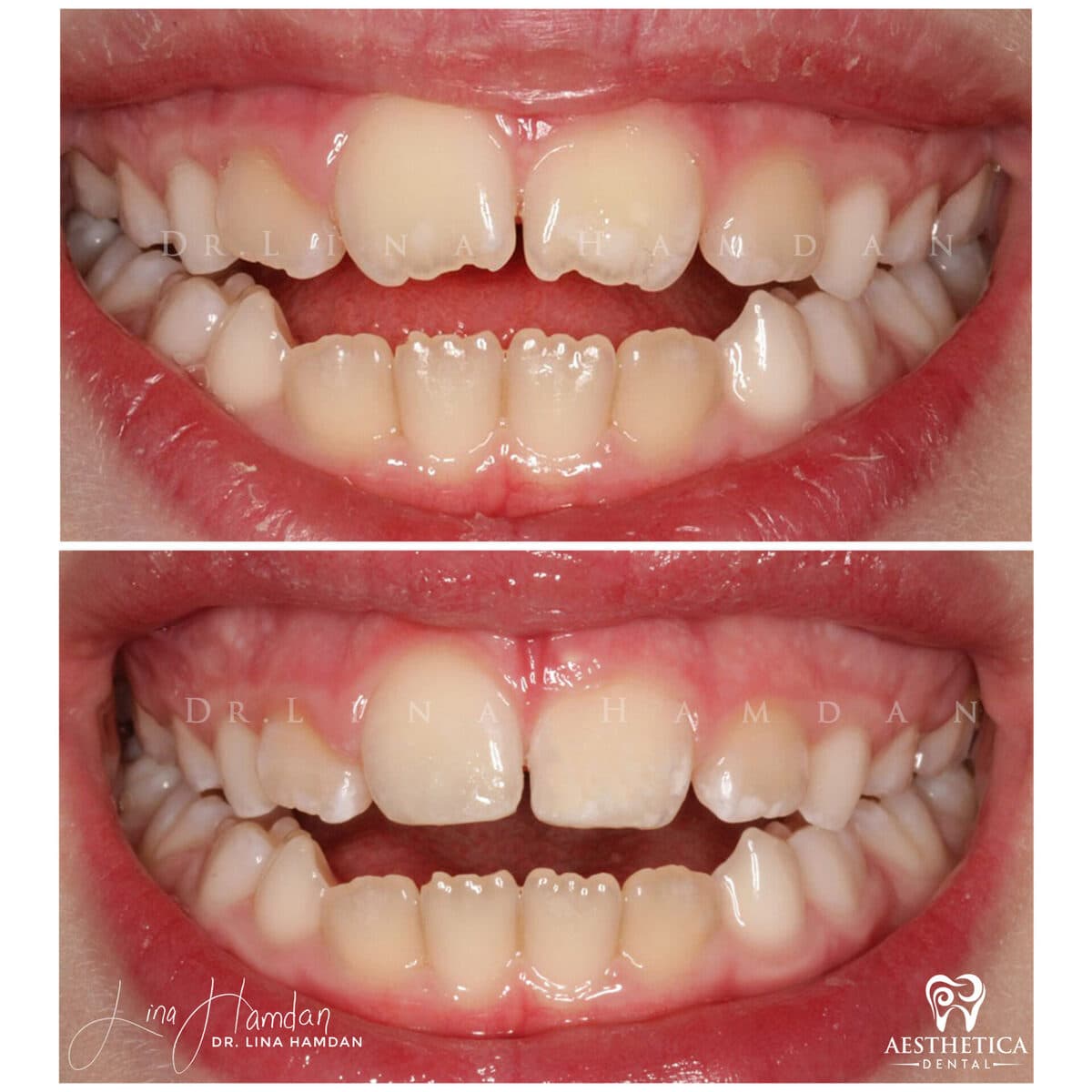 Pediatric dentistry visit, anonymous patient at Aesthetica Dental Naperville (case 3, 2025-05-2-1-2)
