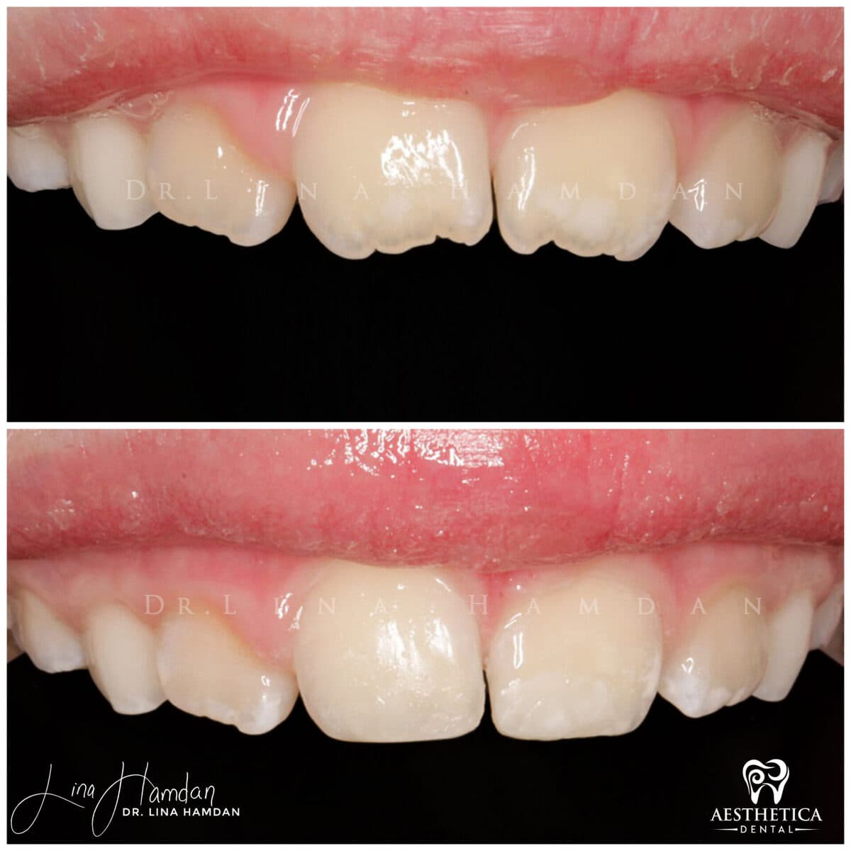 Pediatric dentistry visit, anonymous patient at Aesthetica Dental Naperville (case 4, 2025-05-3-12)