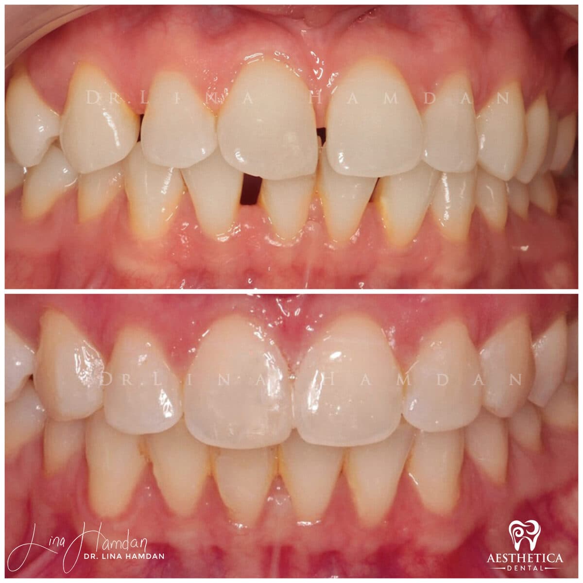 Inman Aligner result, anonymous patient at Aesthetica Dental Naperville (case 4, 2025-01-1-65)