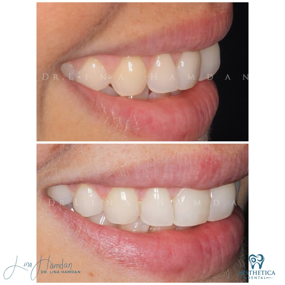 Inman Aligner result, anonymous patient at Aesthetica Dental Naperville (case 5, 2025-01-1-66)