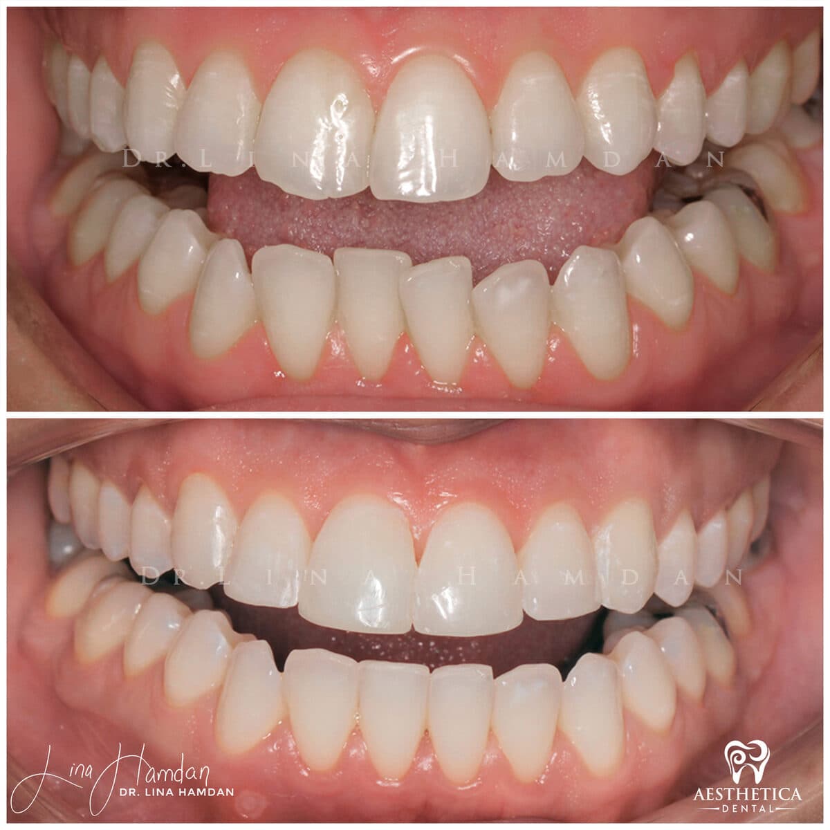 Inman Aligner result, anonymous patient at Aesthetica Dental Naperville (case 6, 2025-01-10-11)
