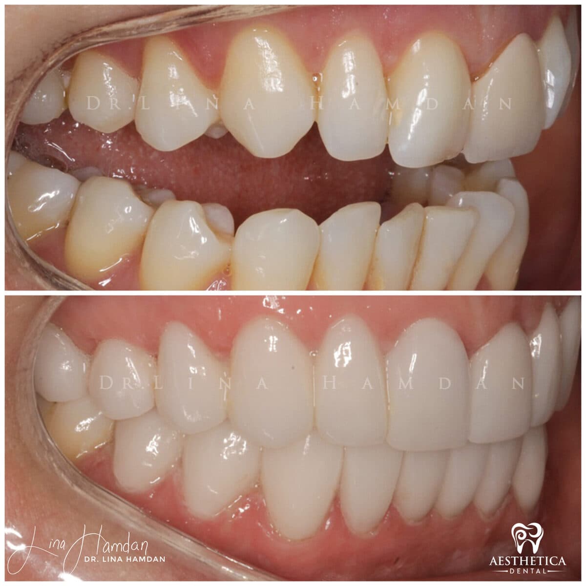 Inman Aligner result, anonymous patient at Aesthetica Dental Naperville (case 8, 2025-01-10-13)