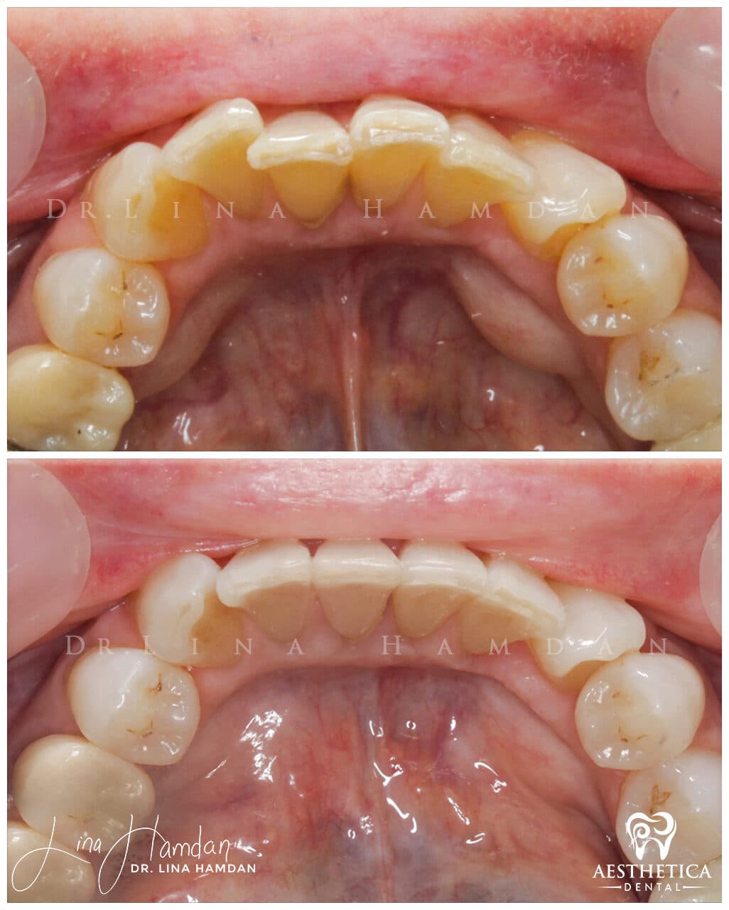Inman Aligner result, anonymous patient at Aesthetica Dental Naperville (case 9, 2025-01-10-14)