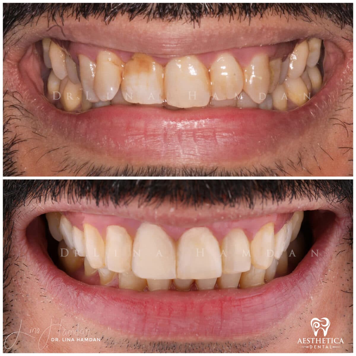 Inman Aligner result, anonymous patient at Aesthetica Dental Naperville (case 11, 2025-01-10-16)