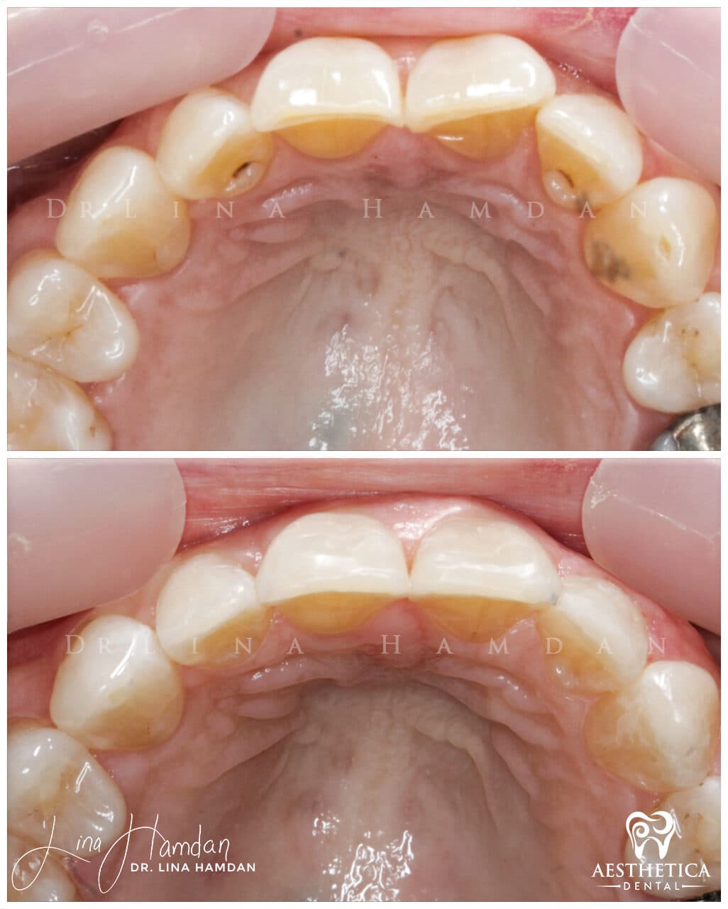 Inman Aligner result, anonymous patient at Aesthetica Dental Naperville (case 12, 2025-01-11-10)
