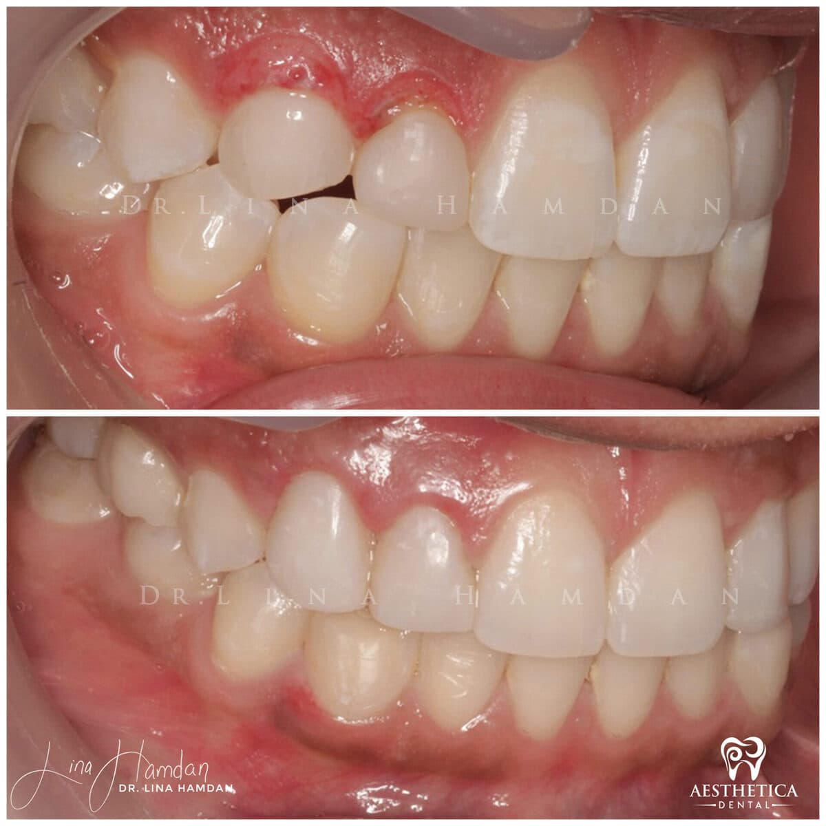 Periodontal treatment result, anonymous patient at Aesthetica Dental Naperville (case 2, 2025-05-2-15)