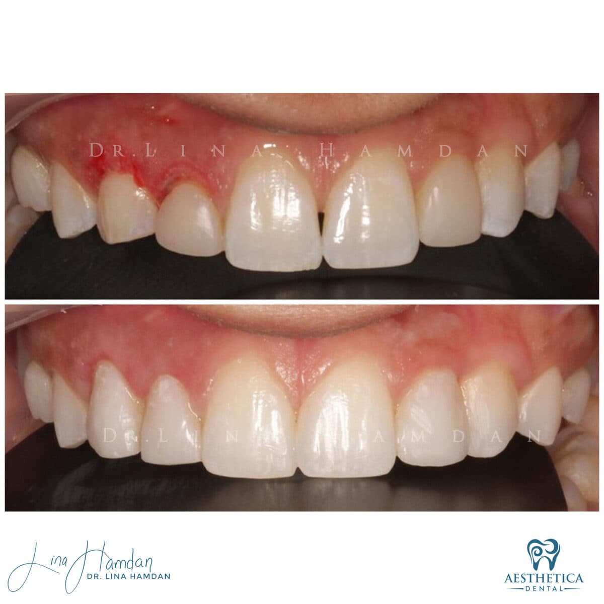 Periodontal treatment result, anonymous patient at Aesthetica Dental Naperville (case 3, 2025-05-4-10)