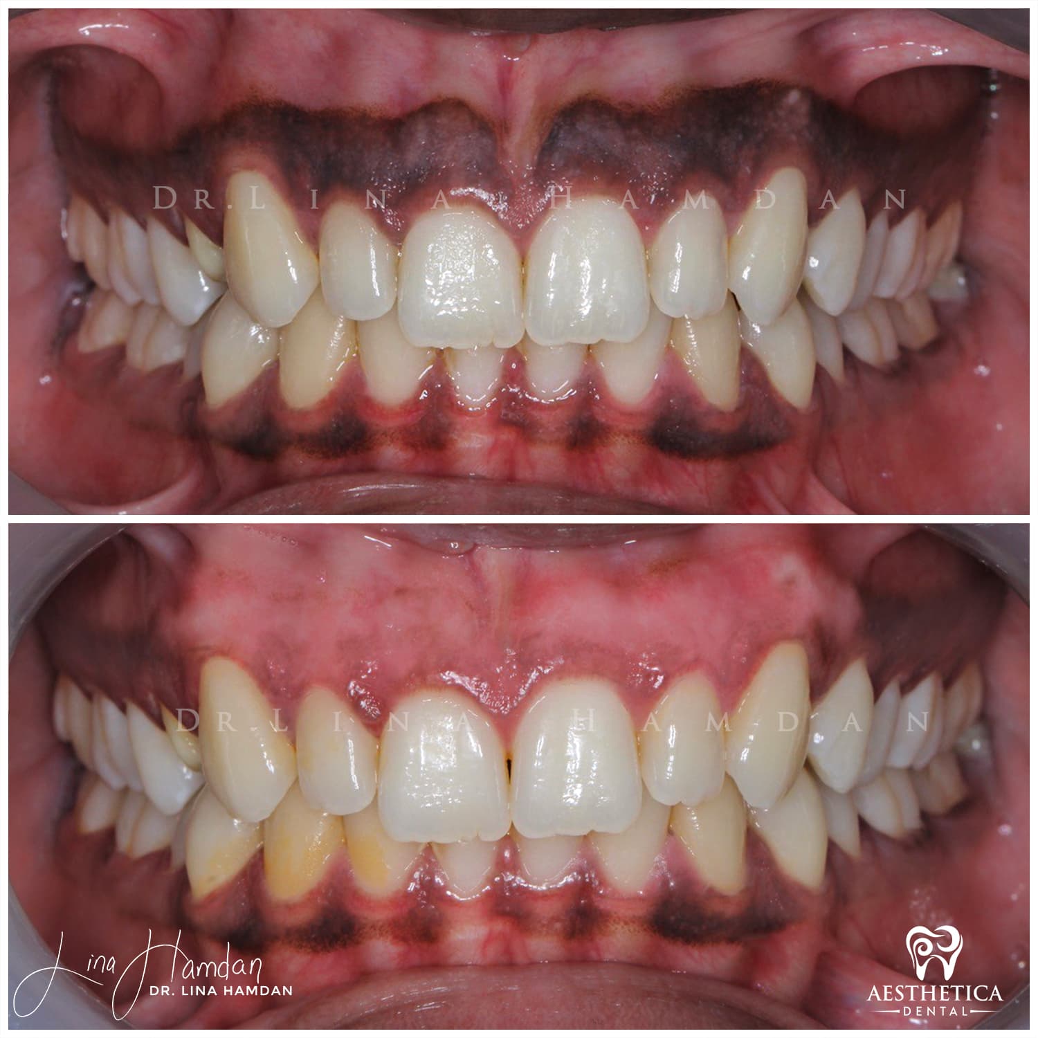 Smile makeover before and after, anonymous patient at Dr. Lina Hamdan Naperville (case 2, 2025-01-1-22)