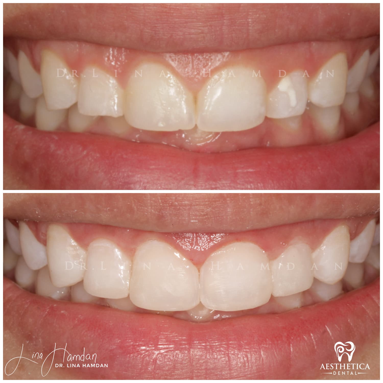 Smile makeover before and after, anonymous patient at Dr. Lina Hamdan Naperville (case 3, 2025-01-1-4)