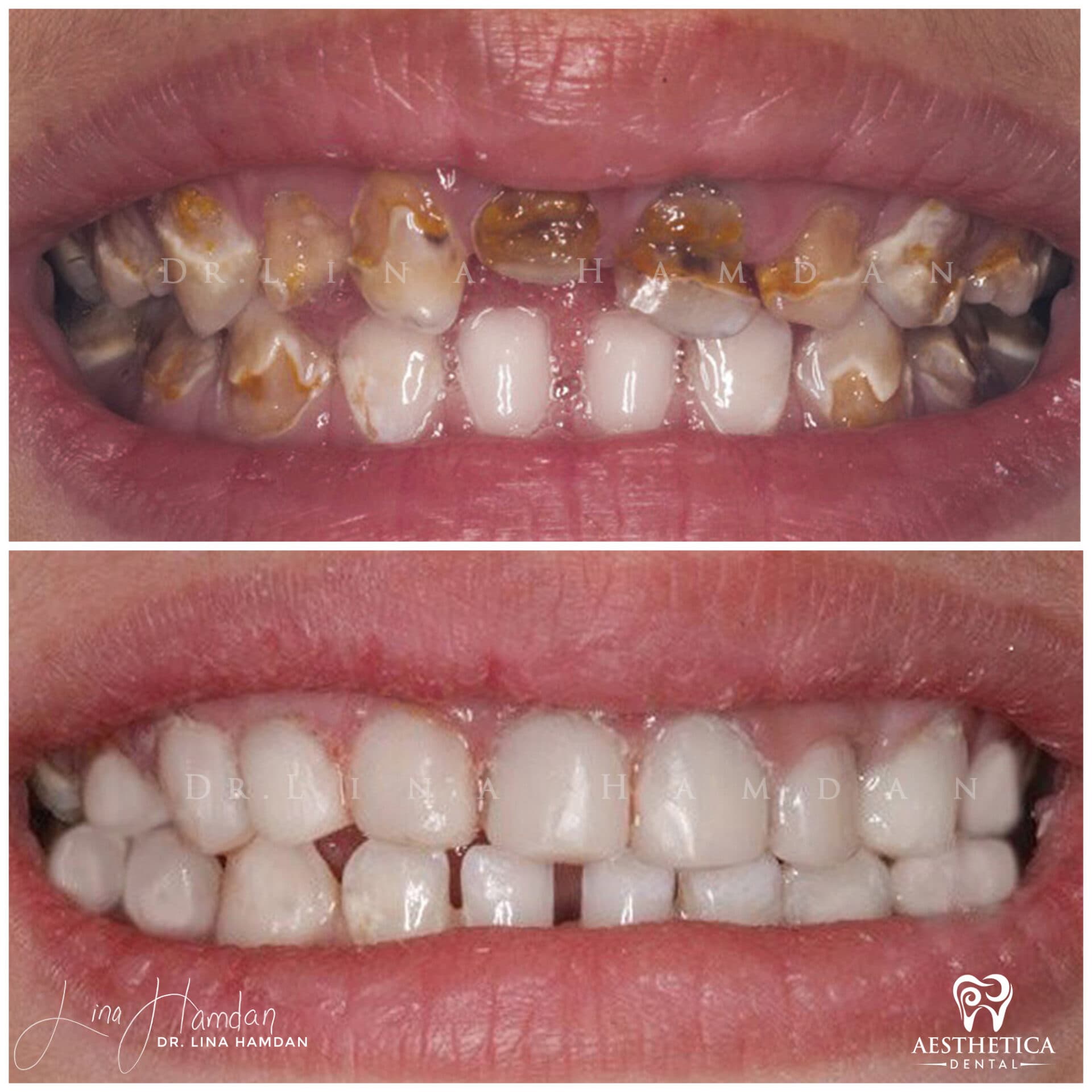 Smile makeover before and after, anonymous patient at Dr. Lina Hamdan Naperville (case 4, 2025-01-1-67)