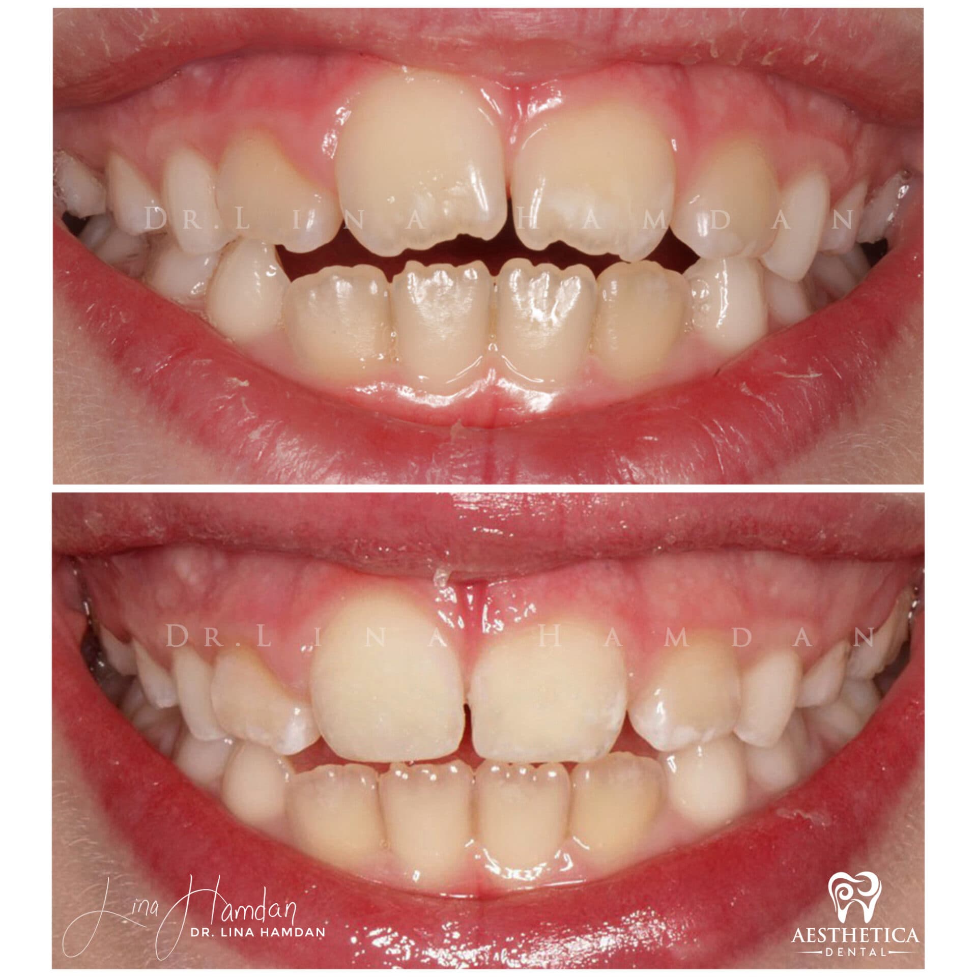 Smile makeover before and after, anonymous patient at Dr. Lina Hamdan Naperville (case 5, 2025-01-1-68)