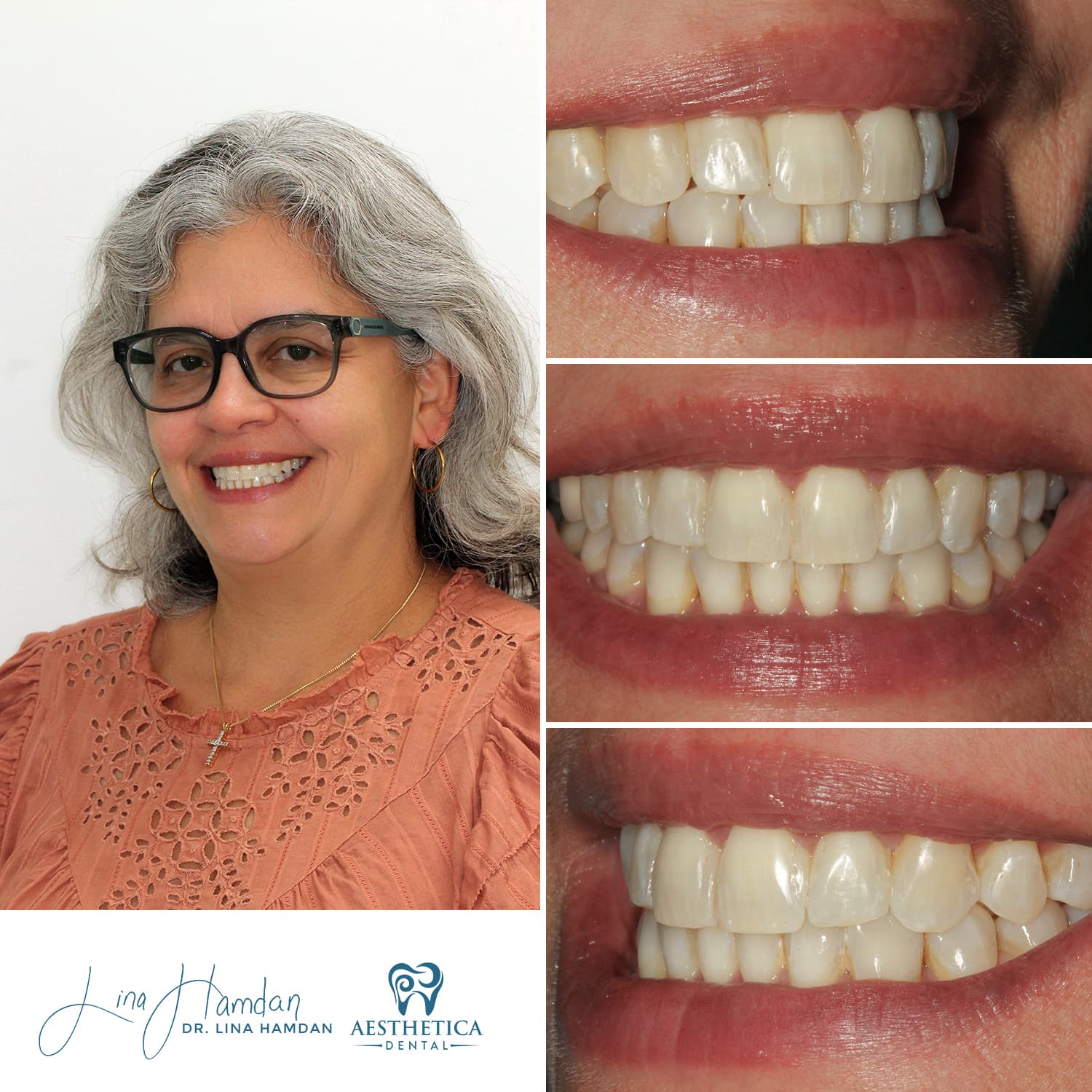 Smile makeover before and after, anonymous patient at Dr. Lina Hamdan Naperville (case 10, 2025-01-Marilyn-with-smile)
