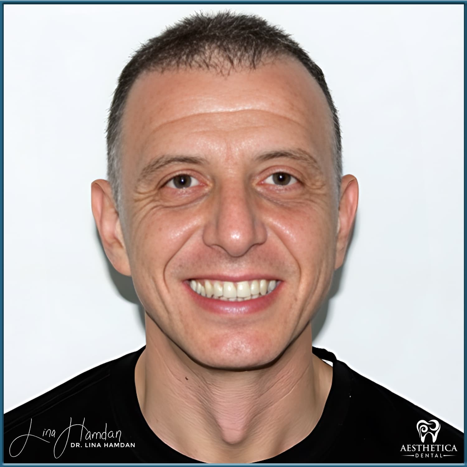 Smile makeover before and after, anonymous patient at Dr. Lina Hamdan Naperville (case 11, 2025-01-Patient-Face-Photo-1)