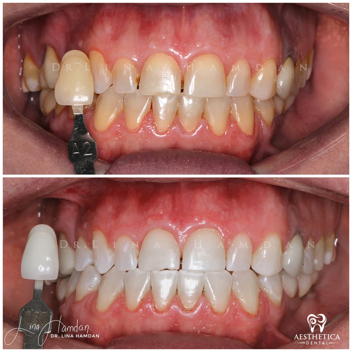 Teeth whitening. — anonymous patient at Aesthetica Dental Naperville