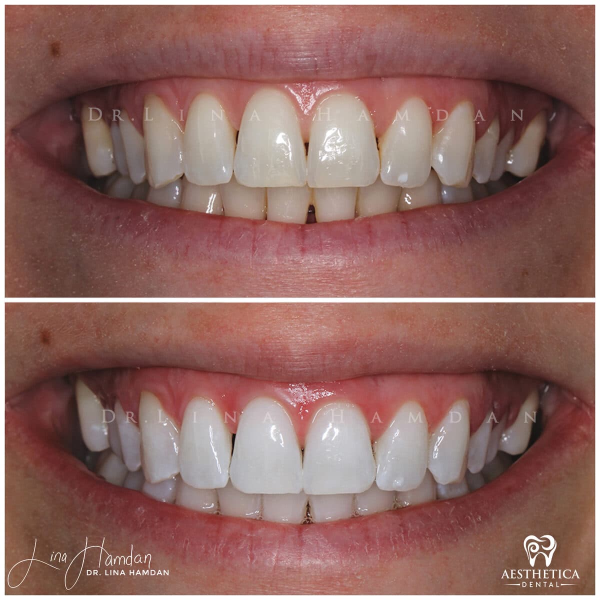 Teeth whitening case 18, anonymous patient at Aesthetica Dental Naperville, photo 1