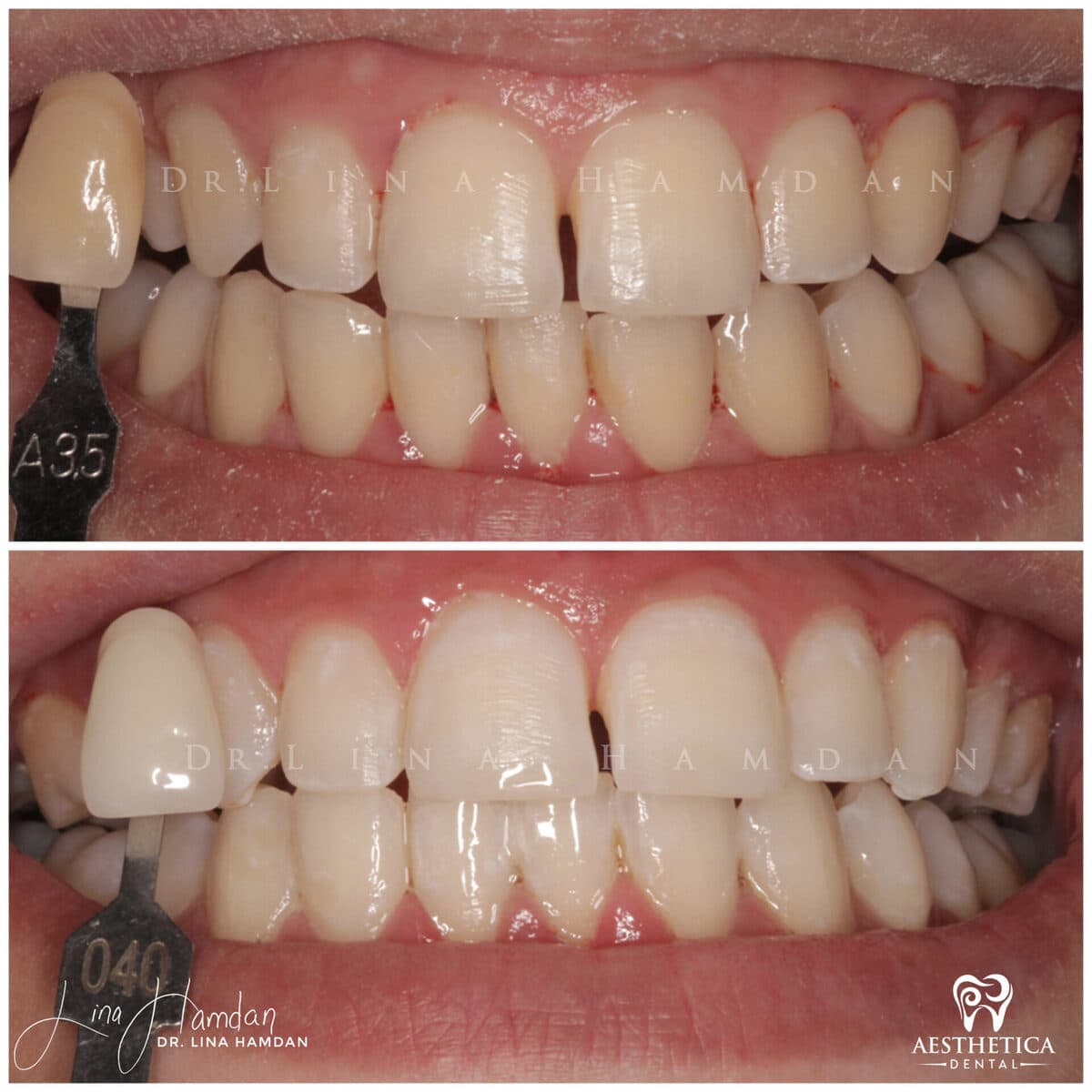 Teeth whitening case 16, anonymous patient at Aesthetica Dental Naperville, photo 2