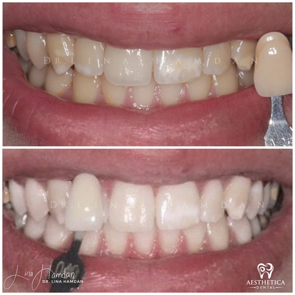 Teeth whitening case 12, anonymous patient at Aesthetica Dental Naperville, photo 2