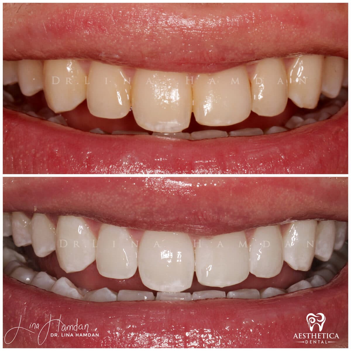 Teeth whitening case 6, anonymous patient at Aesthetica Dental Naperville, photo 3