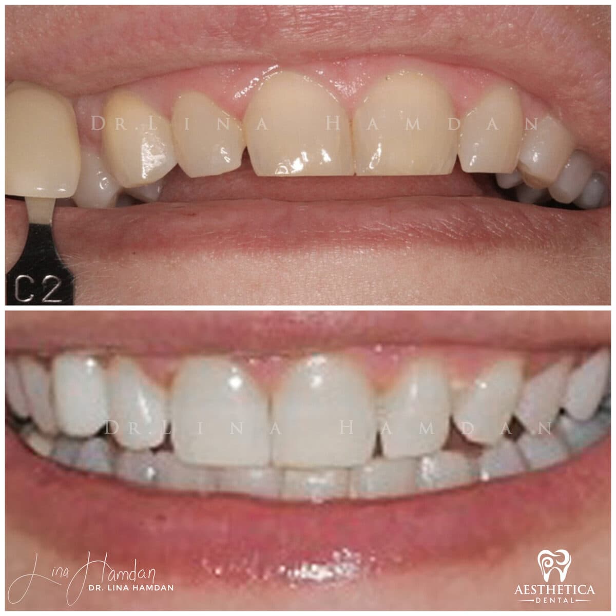 Teeth whitening case 5, anonymous patient at Aesthetica Dental Naperville, photo 2