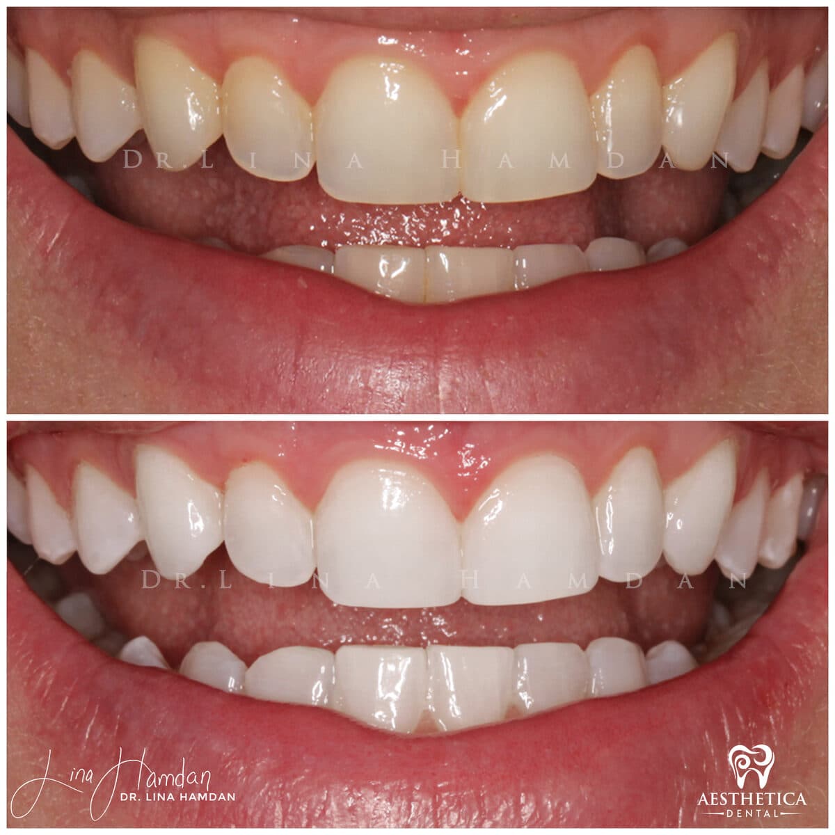 Teeth whitening case 13, anonymous patient at Aesthetica Dental Naperville, photo 2