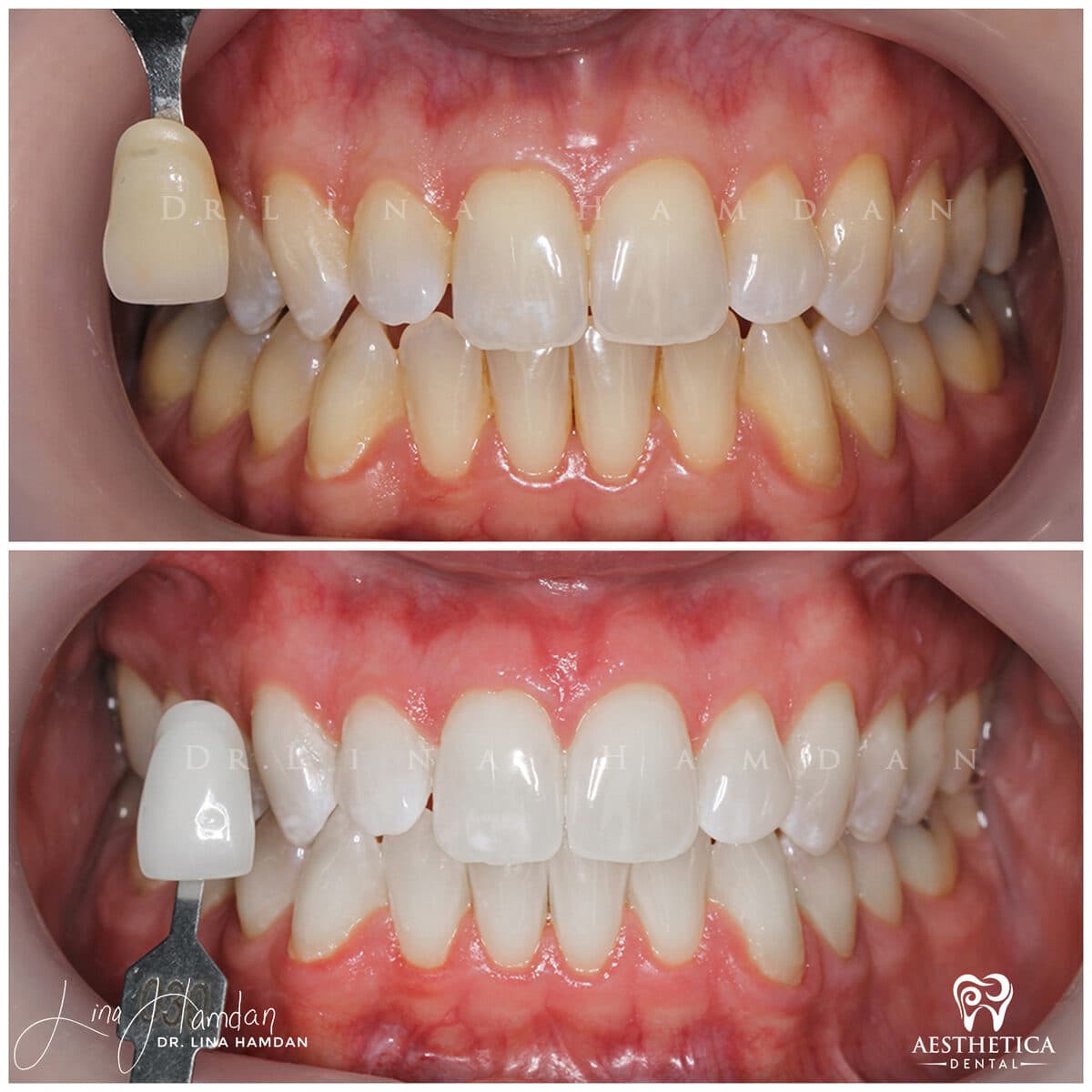 Teeth whitening case 4, anonymous patient at Aesthetica Dental Naperville, photo 2