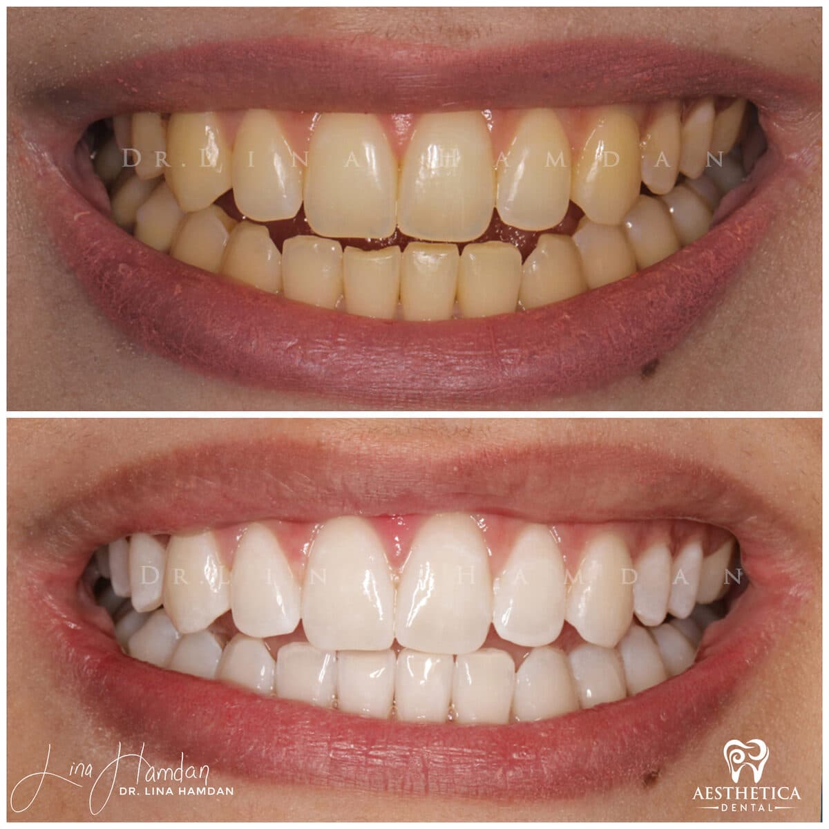 Teeth whitening case 2, anonymous patient at Aesthetica Dental Naperville, photo 2