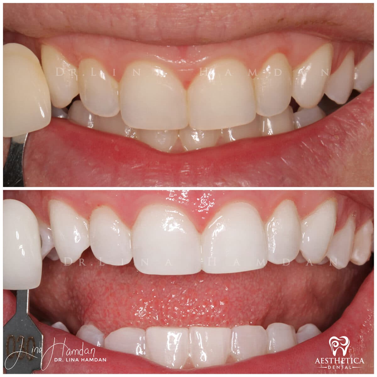 Teeth whitening case 13, anonymous patient at Aesthetica Dental Naperville, photo 3