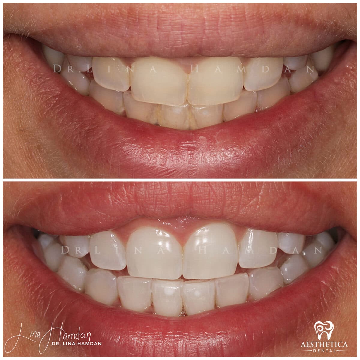 Teeth whitening case 14, anonymous patient at Aesthetica Dental Naperville, photo 3