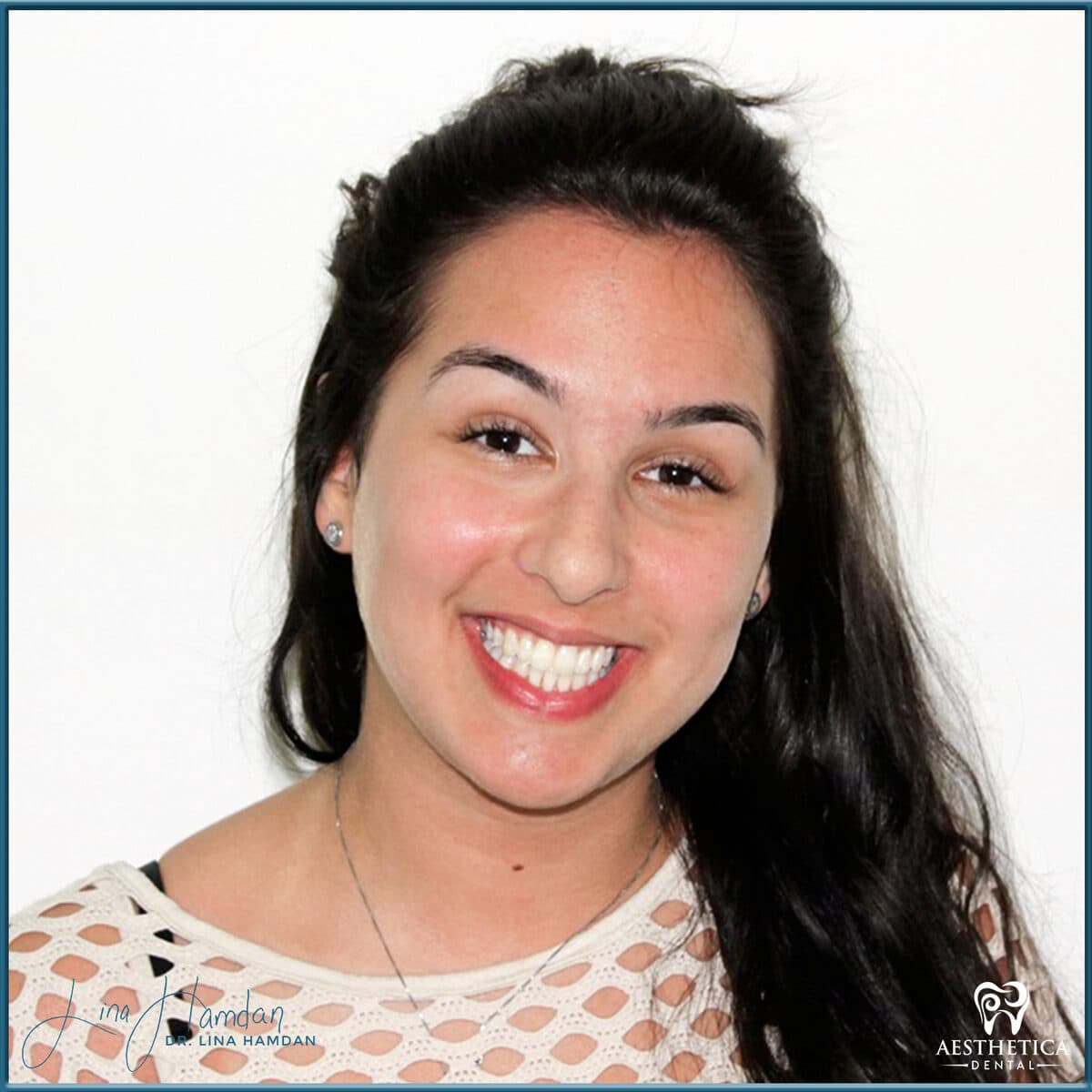 Teeth whitening case 9, anonymous patient at Aesthetica Dental Naperville, photo 1