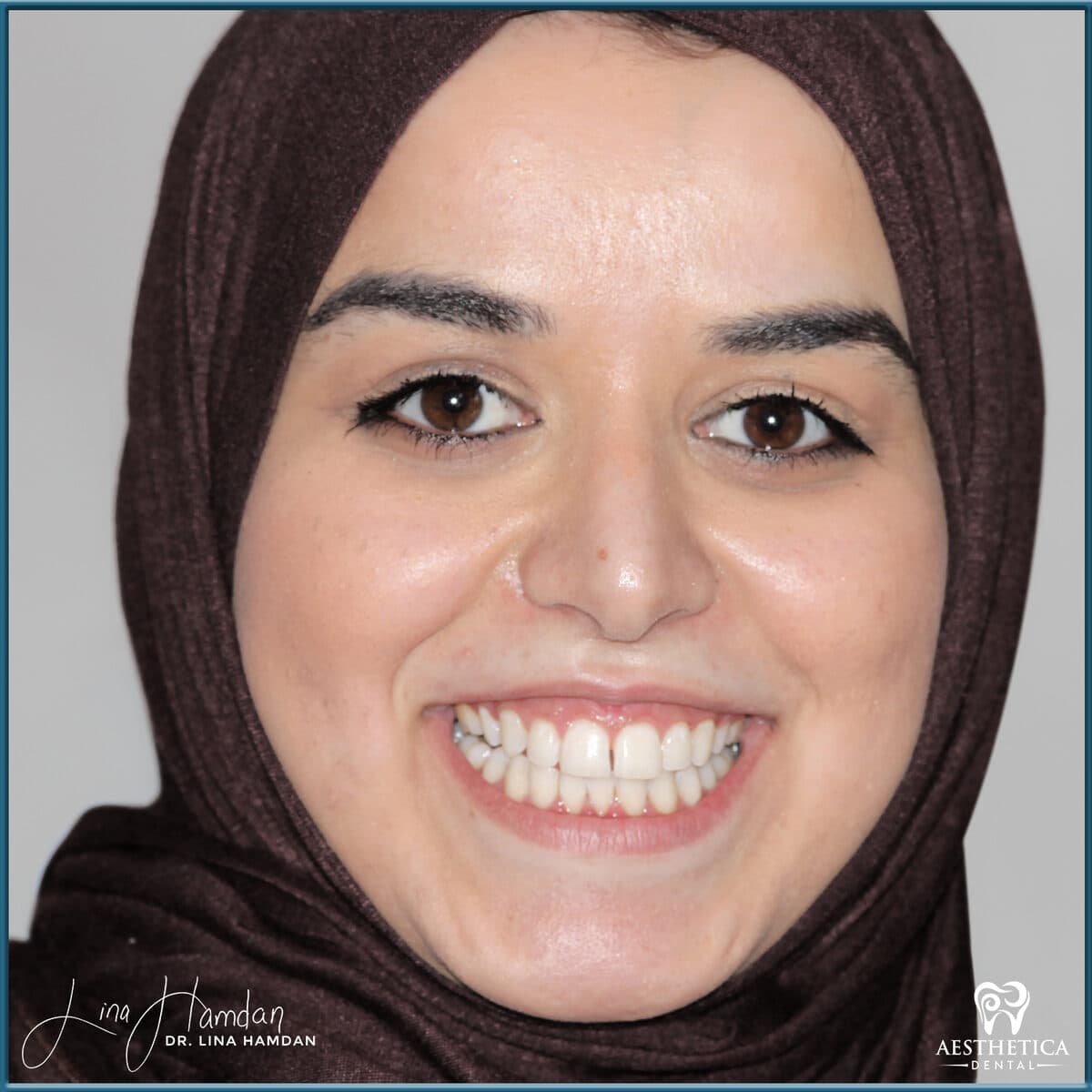 Teeth whitening case 16, anonymous patient at Aesthetica Dental Naperville, photo 1
