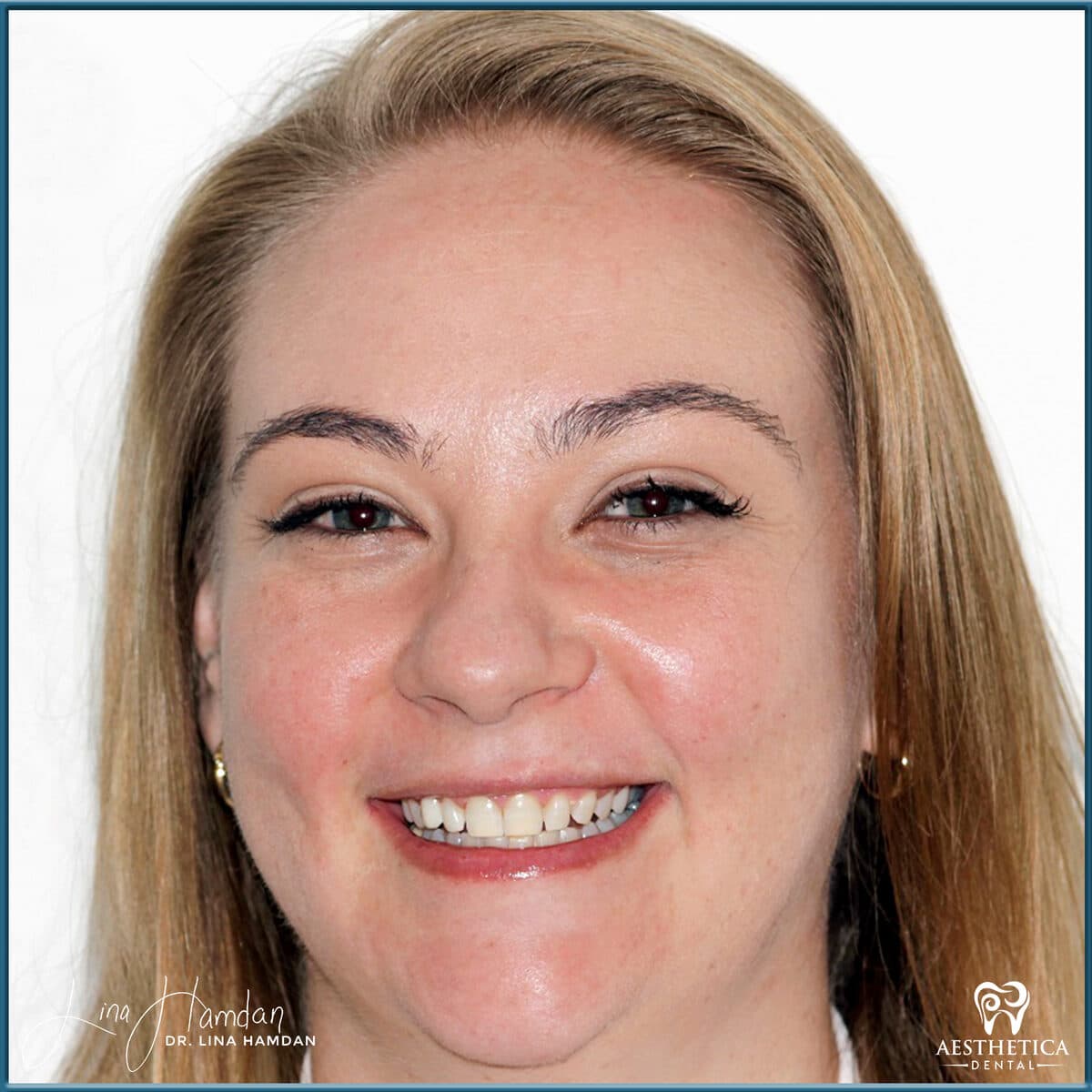 Teeth whitening case 5, anonymous patient at Aesthetica Dental Naperville, photo 1