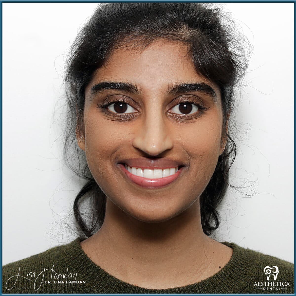 Teeth whitening case 15, anonymous patient at Aesthetica Dental Naperville, photo 1