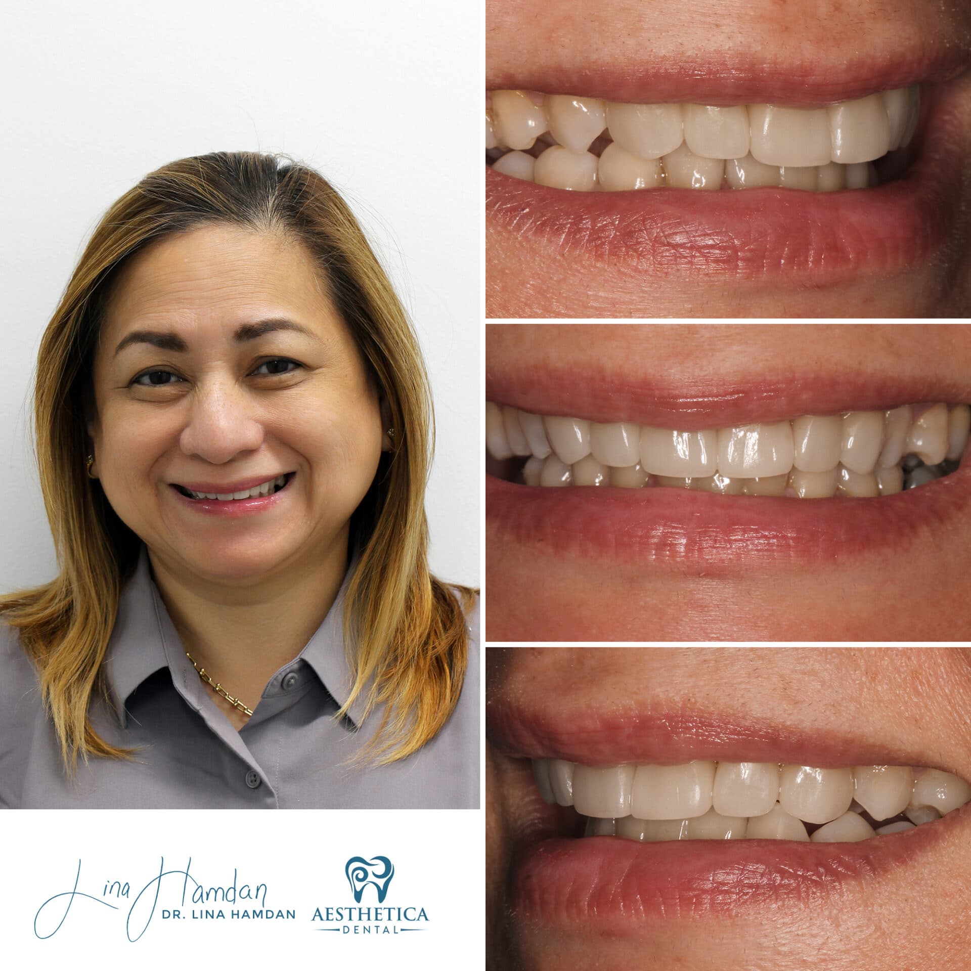 Veneers: patient result by Dr. Lina Hamdan