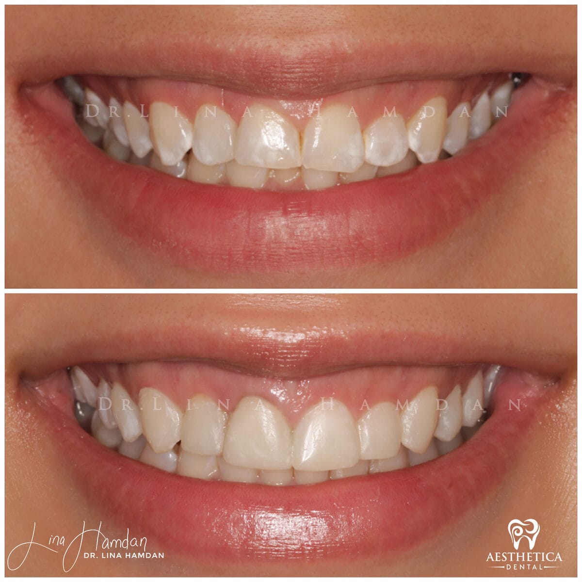 Composite bonding.: anonymous before-and-after case photograph from Aesthetica Dental Naperville