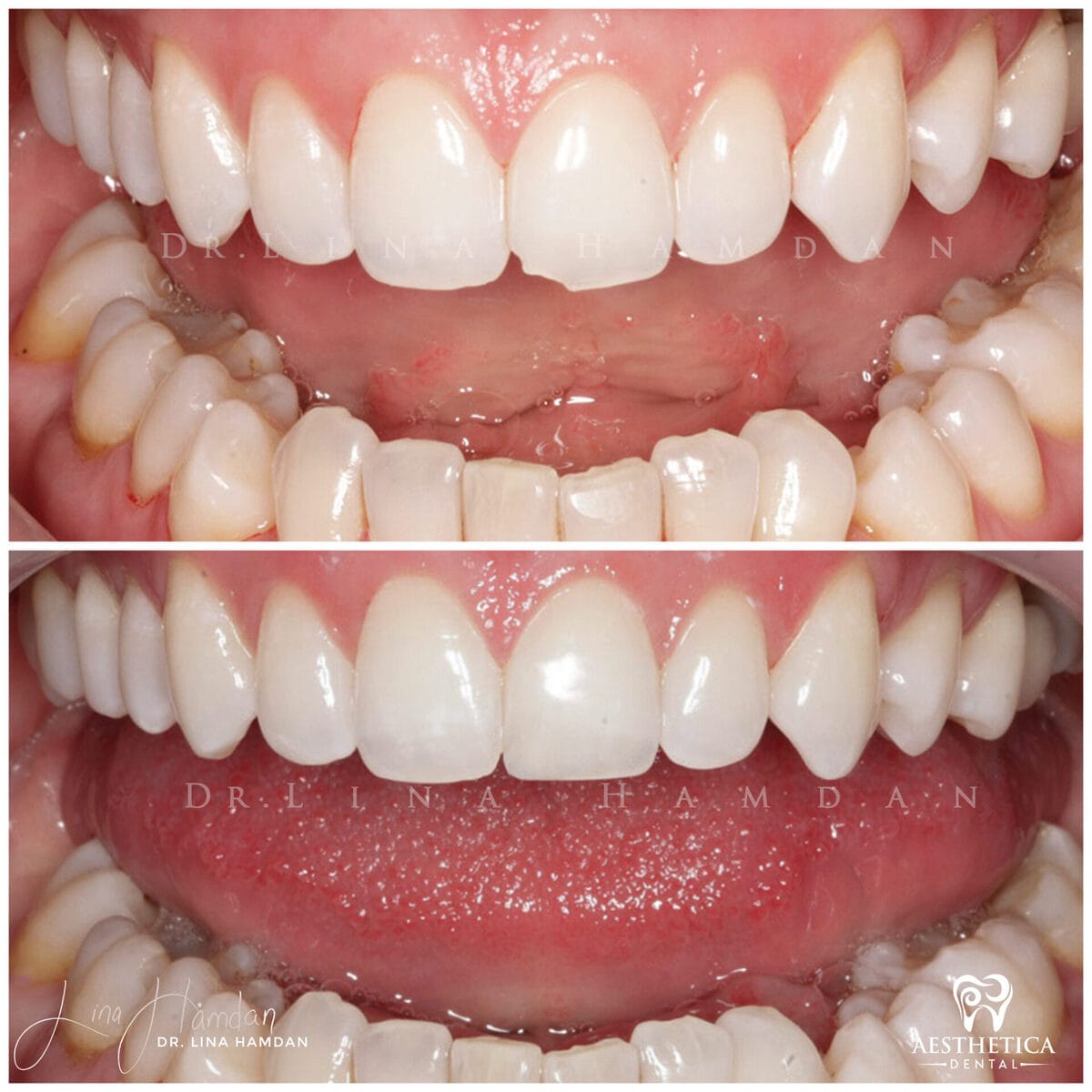 Composite bonding result, anonymous patient at Aesthetica Dental Naperville (case 9, 2025-01-1-51)