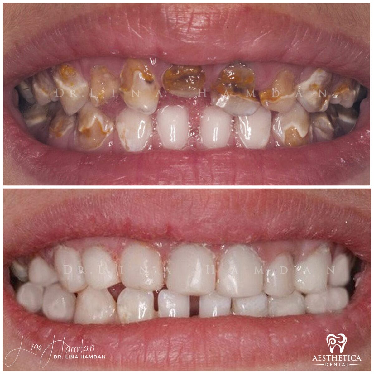 Composite bonding result, anonymous patient at Aesthetica Dental Naperville (case 12, 2025-01-1-54)