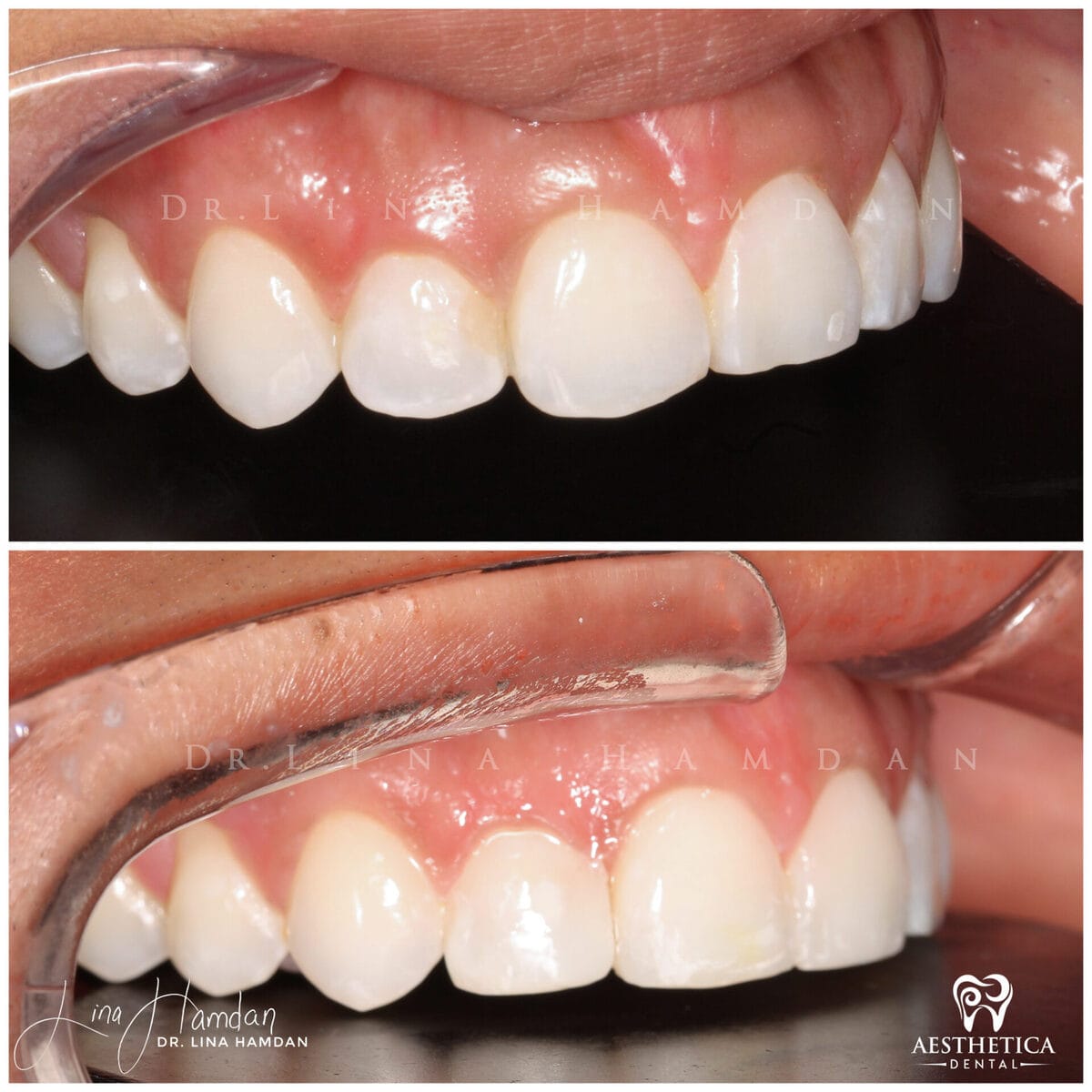 Composite bonding: anonymous case 20 from Aesthetica Dental Naperville