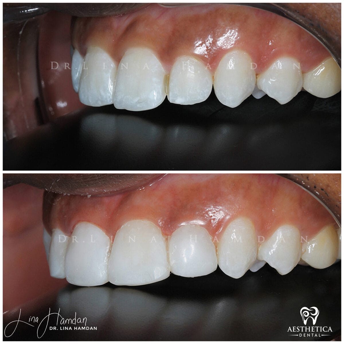 Composite bonding: anonymous case 22 from Aesthetica Dental Naperville
