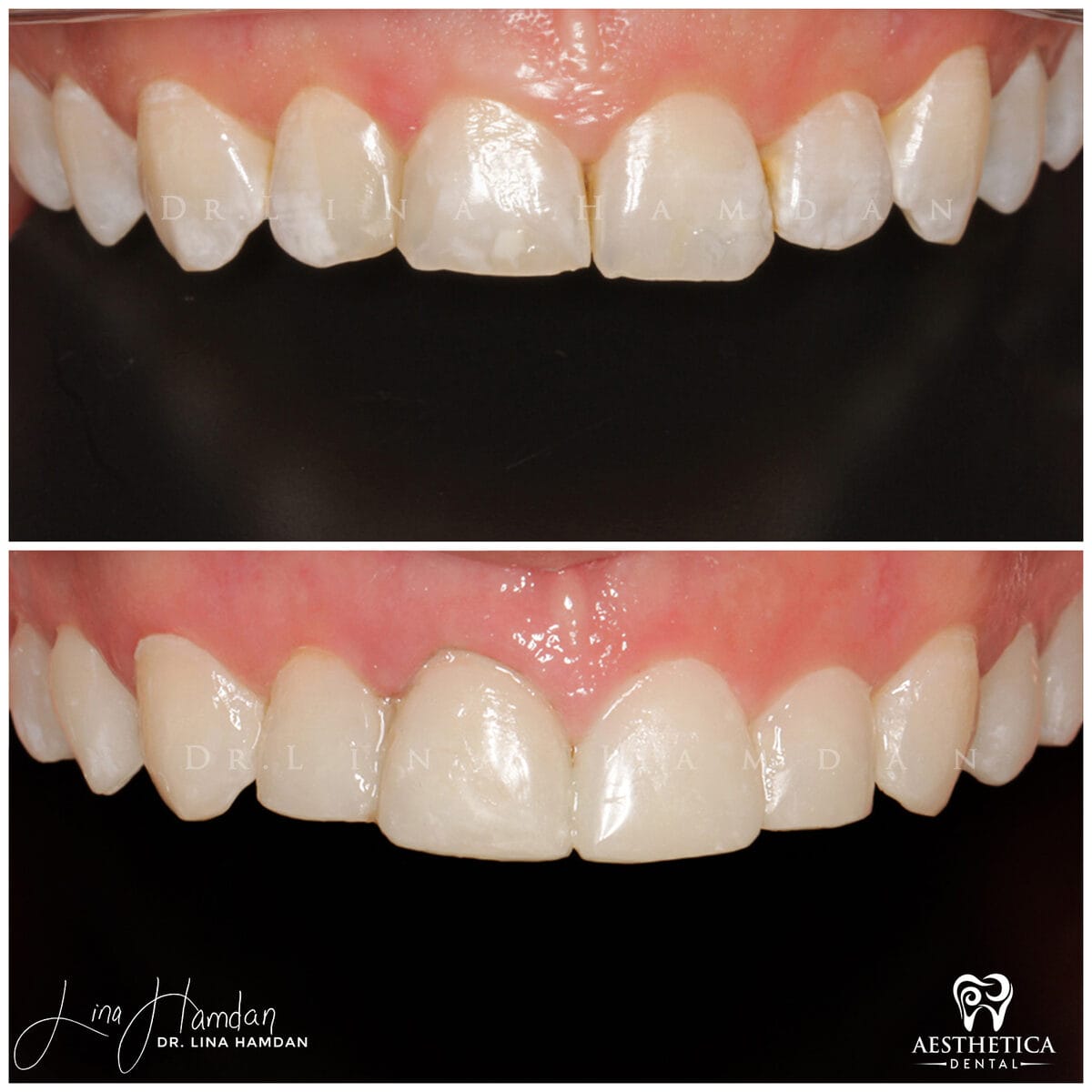 Composite bonding: anonymous case 23 from Aesthetica Dental Naperville