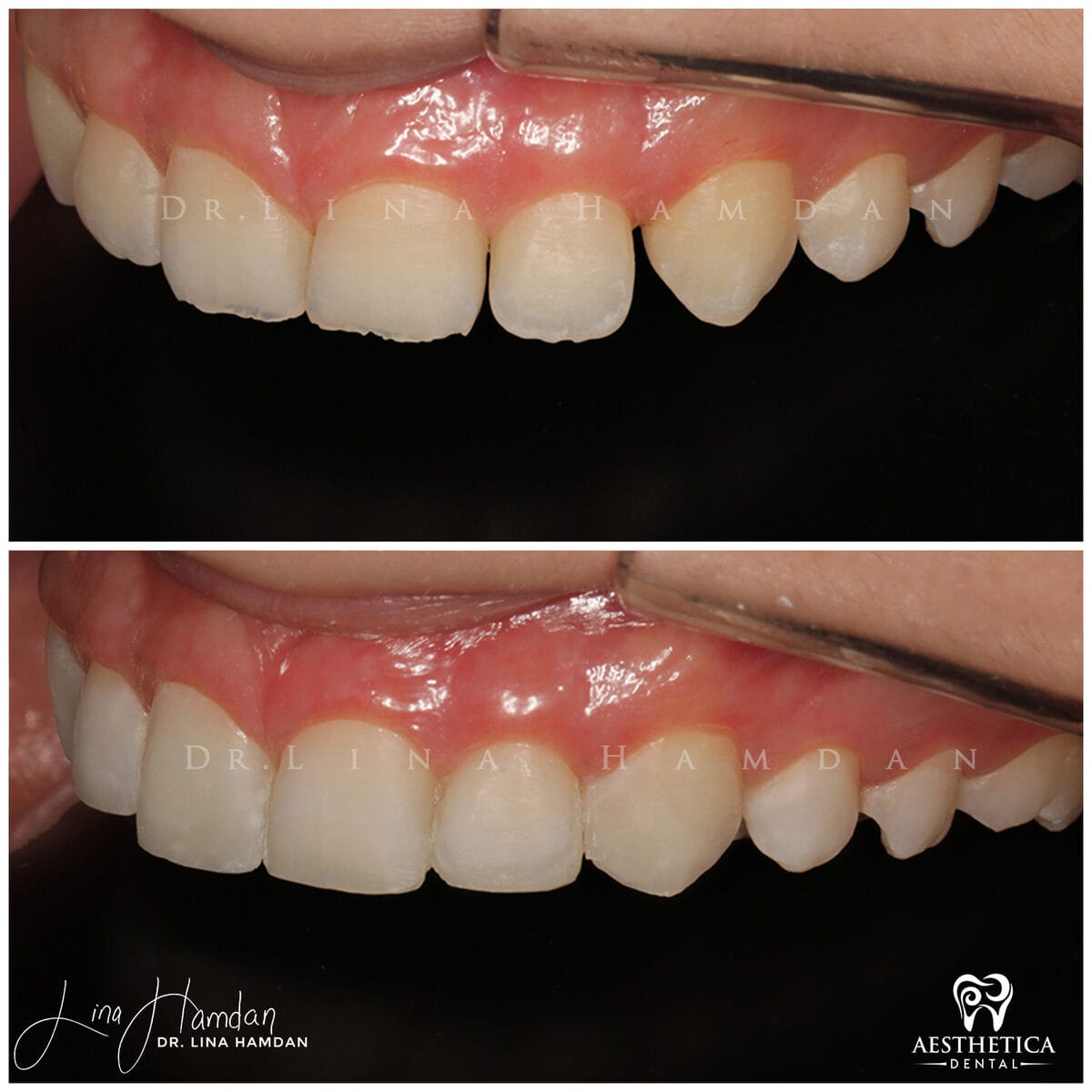 Composite bonding: anonymous case 31 from Aesthetica Dental Naperville