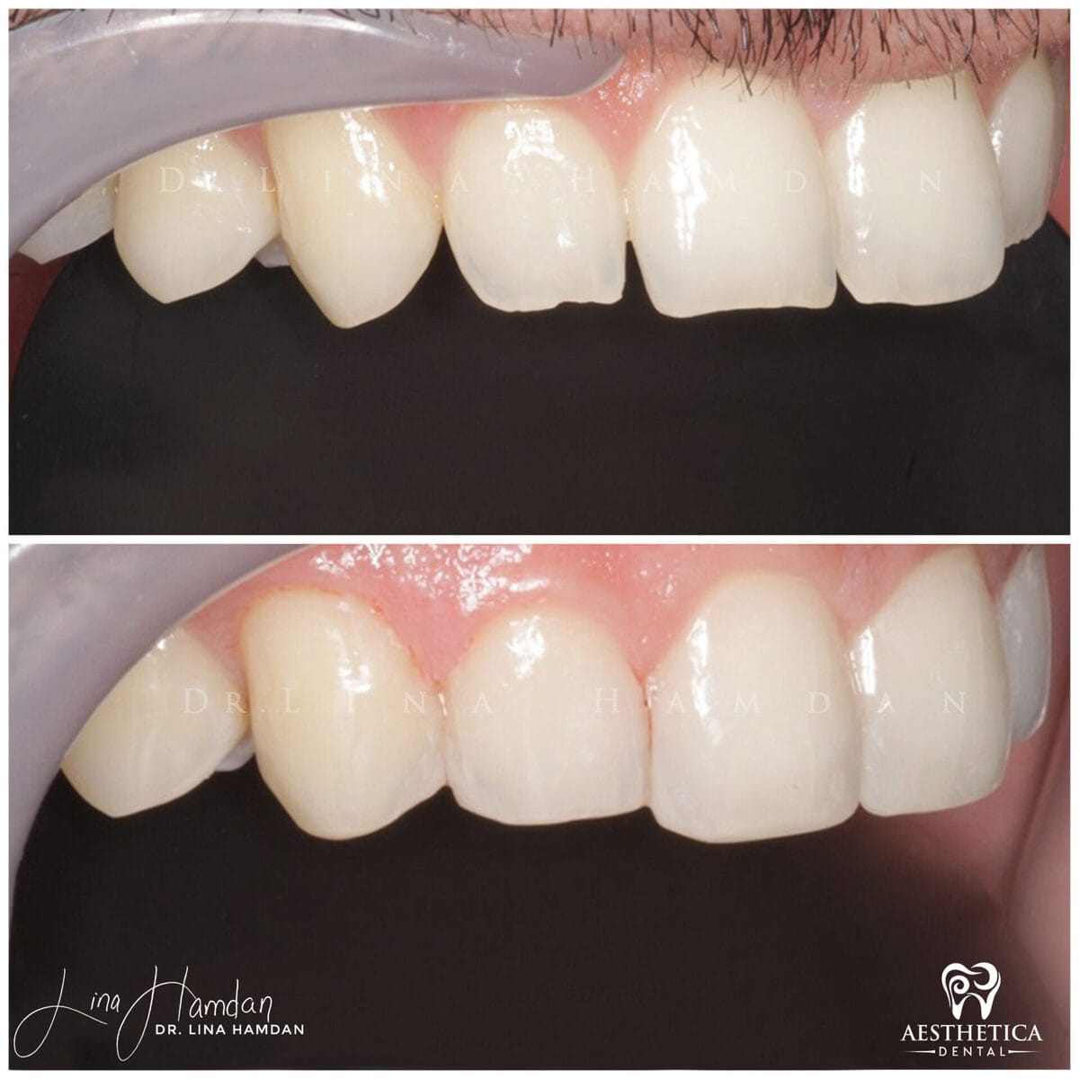 Composite bonding: anonymous case 35 from Aesthetica Dental Naperville