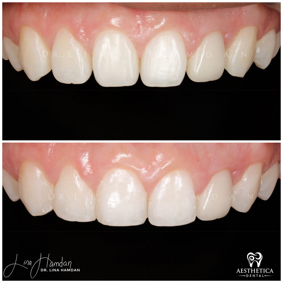 Composite bonding: anonymous case 39 from Aesthetica Dental Naperville