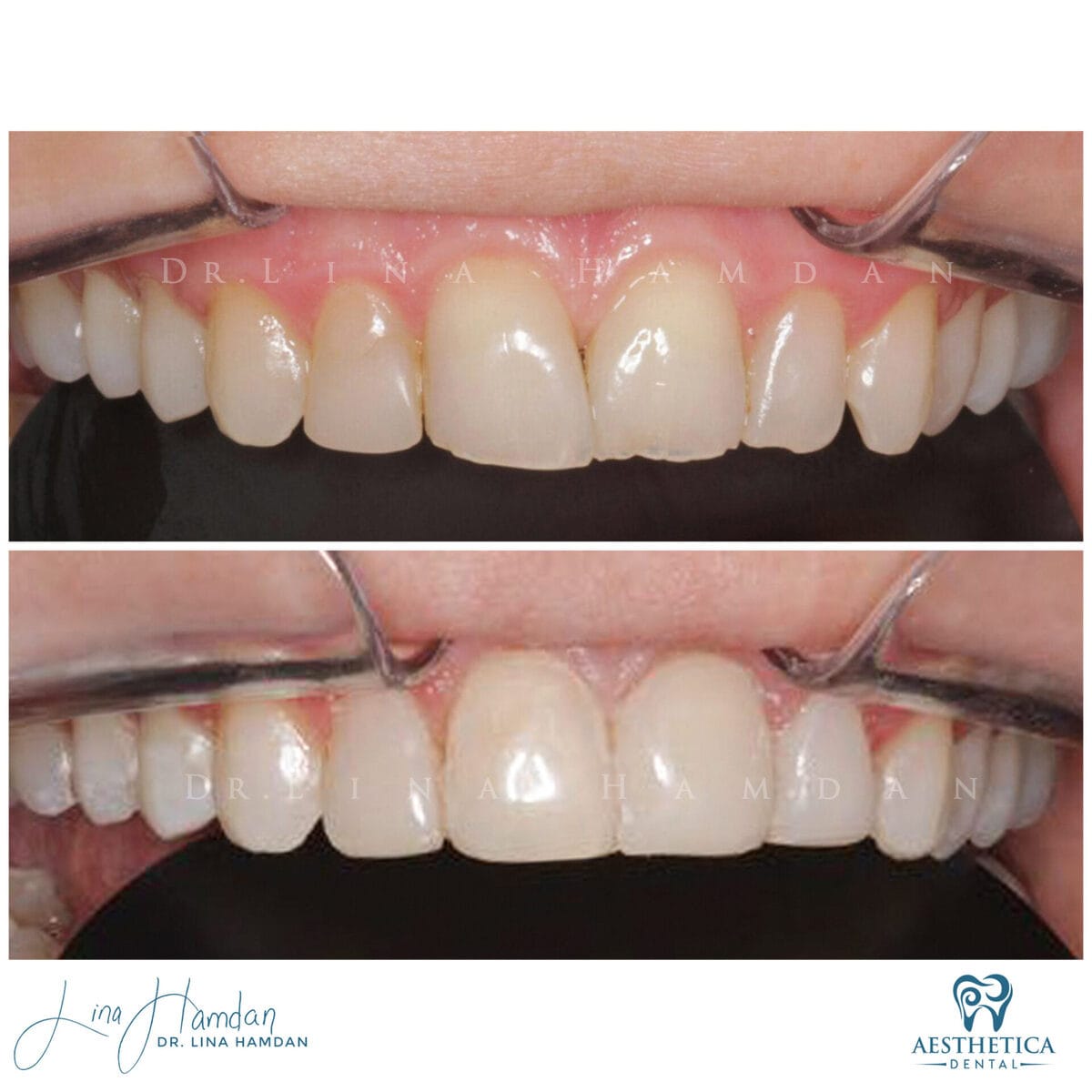 Composite bonding: anonymous case 45 from Aesthetica Dental Naperville