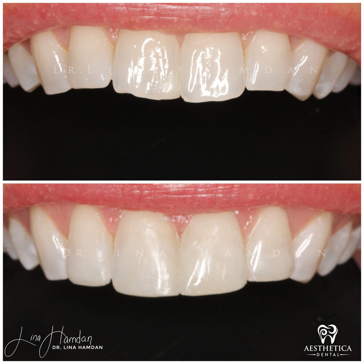Composite bonding: anonymous case 50 from Aesthetica Dental Naperville