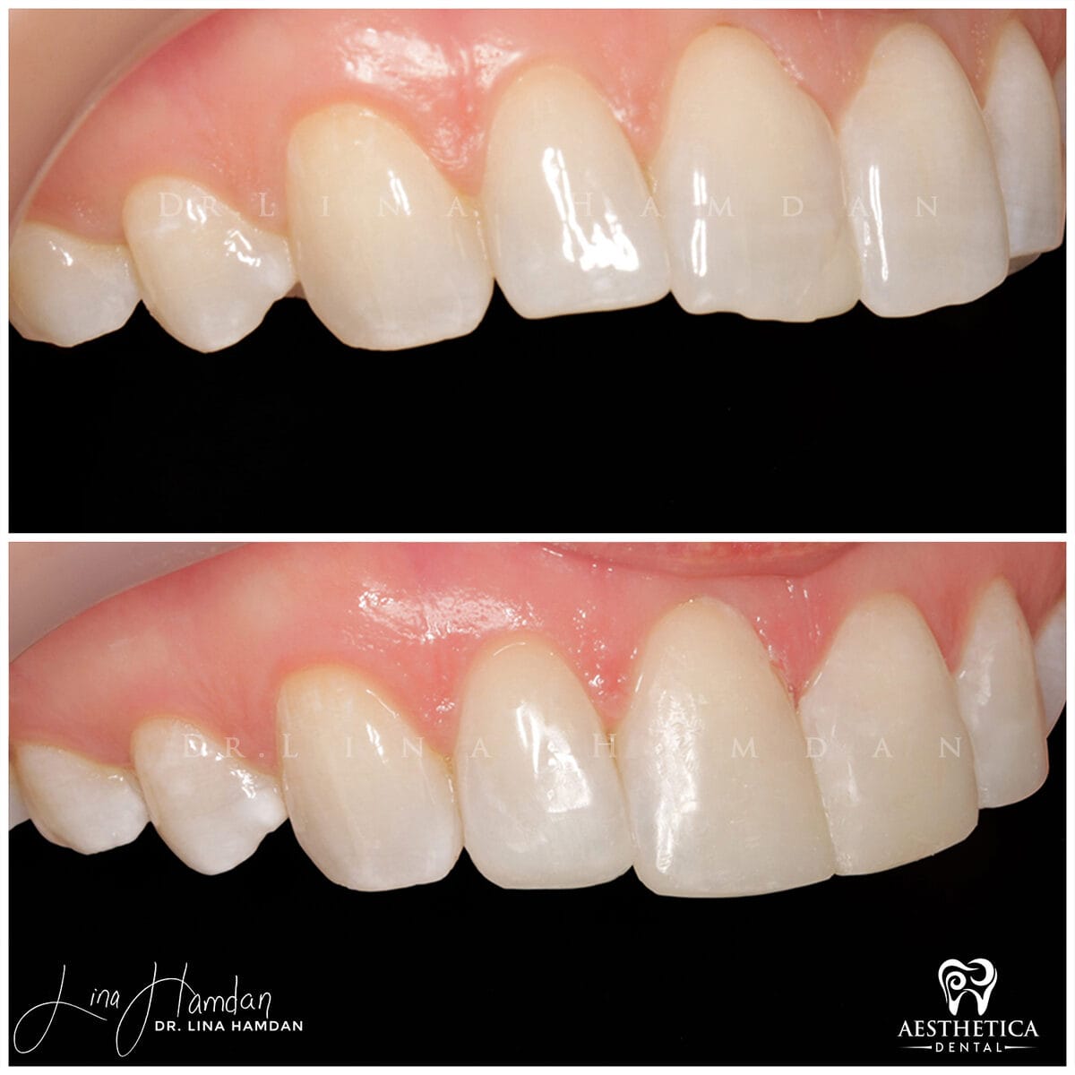 Composite bonding: anonymous case 57 from Aesthetica Dental Naperville