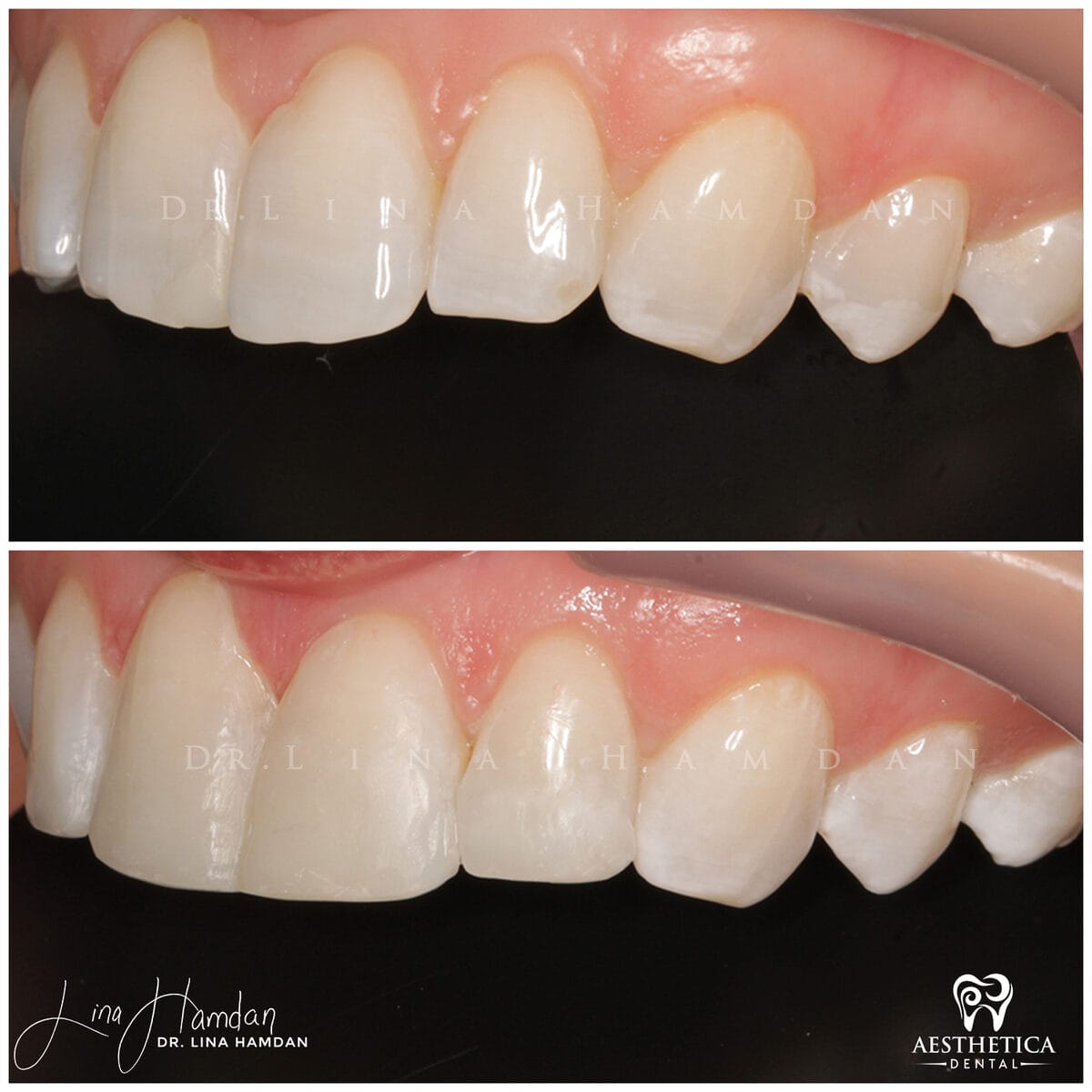 Composite bonding: anonymous case 60 from Aesthetica Dental Naperville