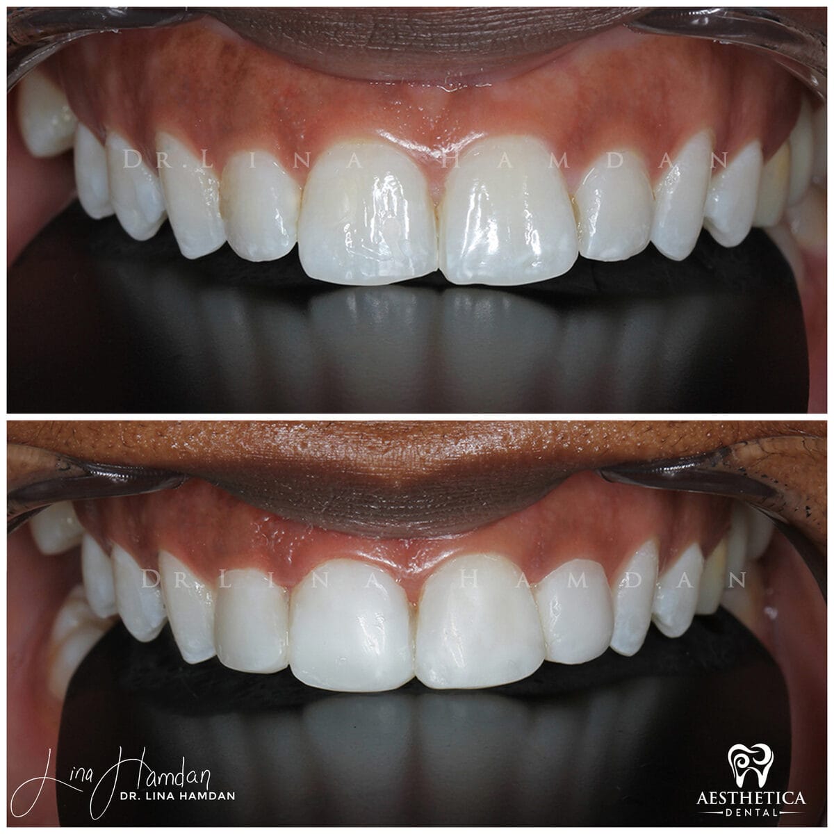 Composite bonding: anonymous case 68 from Aesthetica Dental Naperville
