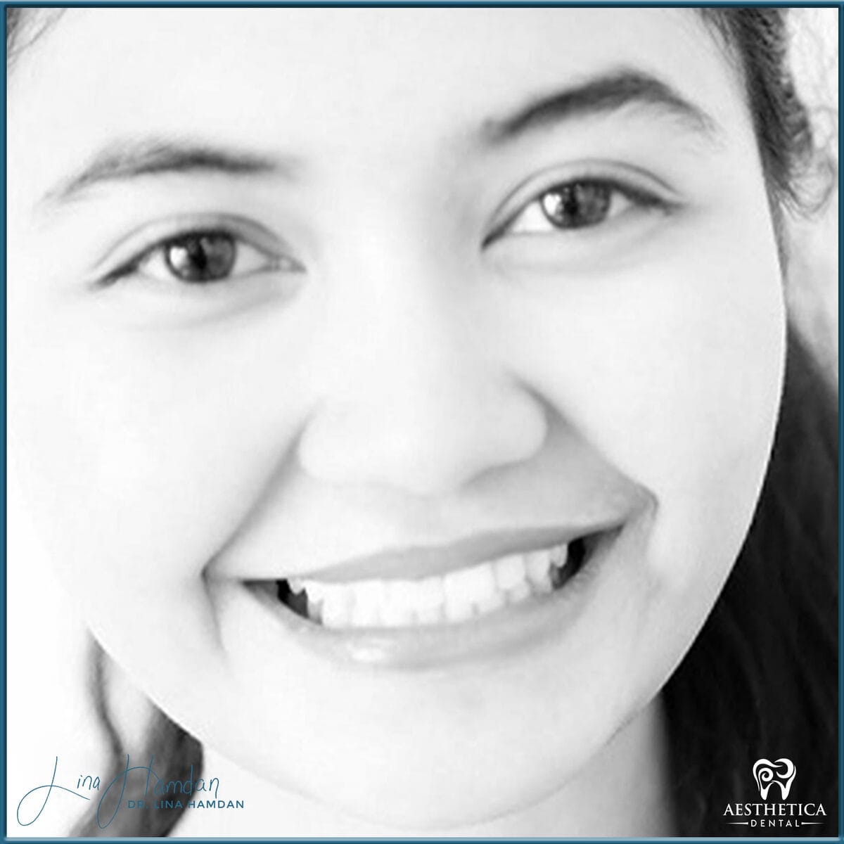 Composite bonding: anonymous case 73 from Aesthetica Dental Naperville