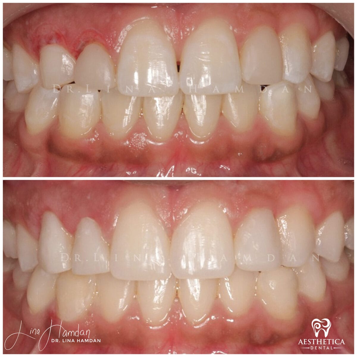 Composite bonding: anonymous case 94 from Aesthetica Dental Naperville